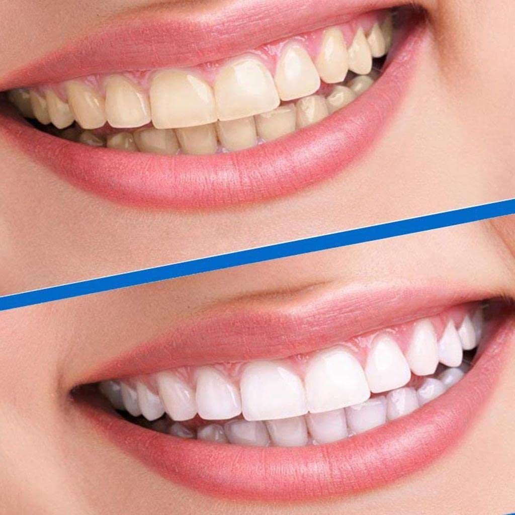 Teeth whitening strips